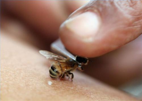 Cómo tratar una picadura de abeja