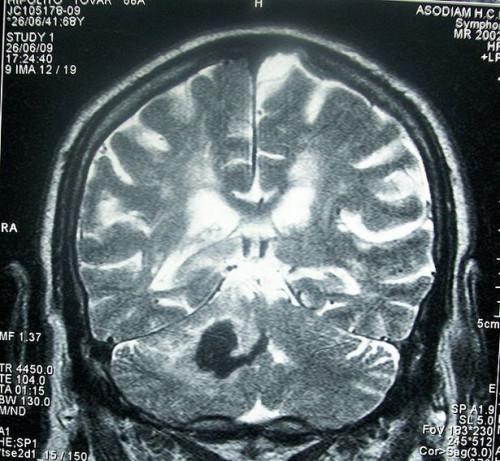 Signos y síntomas de accidente cerebrovascular para los hombres